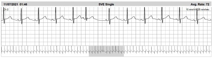 Jess-ECG-strip-after-marathon
