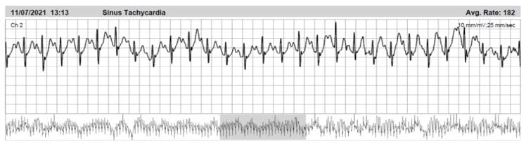 Jess-ECG-strip-during-marathon